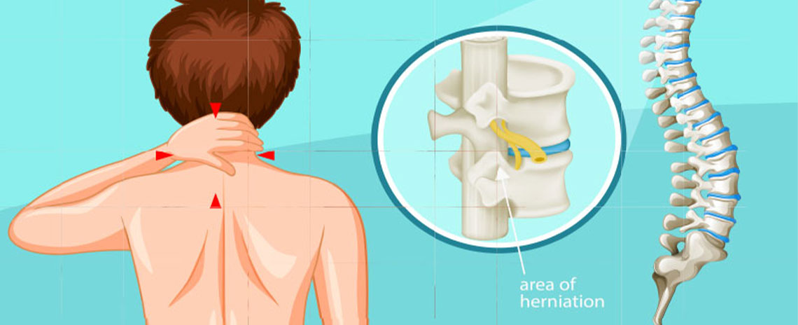 Diagram of pinched nerve in neck